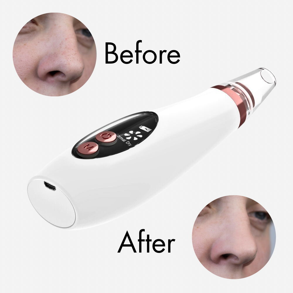 ZR-9 Blackheads Remover